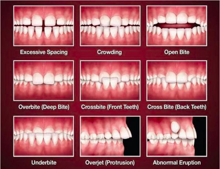 Invisible Braces, Best Dental Clinic In Hyderabad